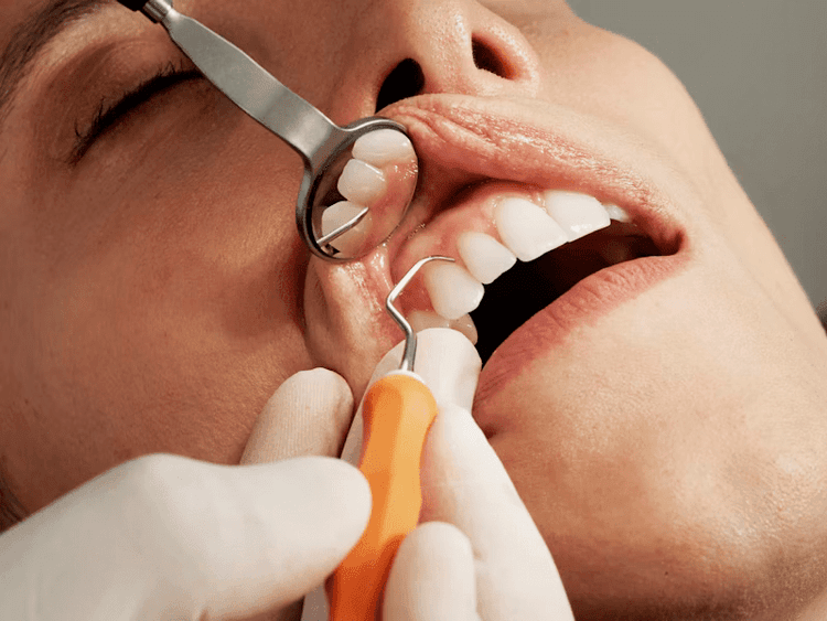 پریمیل اباتمنت، قطعه پروتزی ایمپلنت آگات